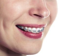 Smiling women with braces
