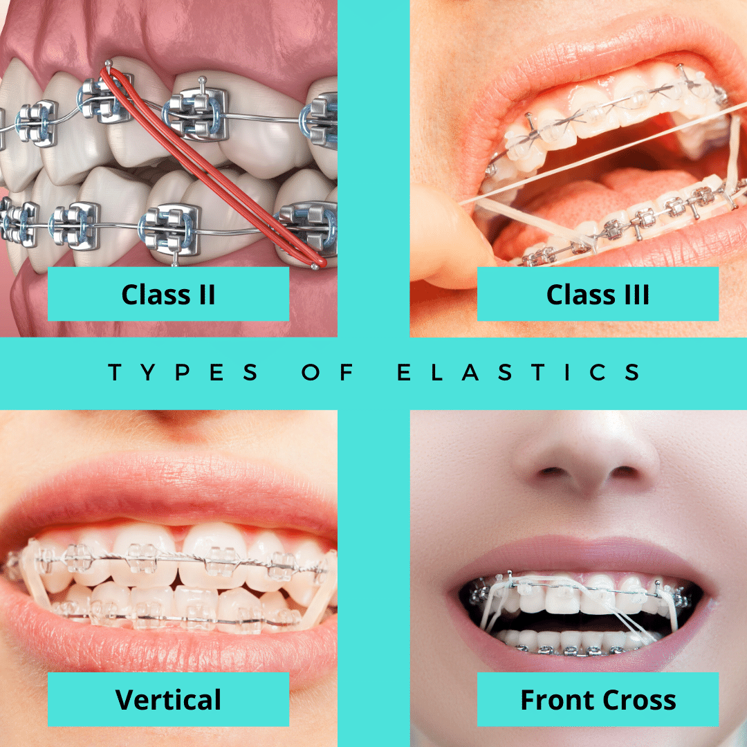 What Are Interarch Rubber Bands?