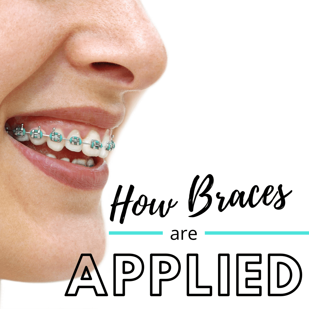 how to apply your own braces