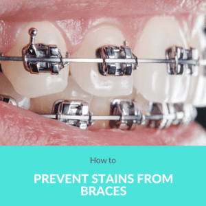 How to Prevent Stains From Braces