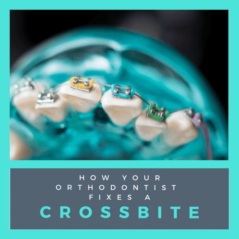 How Your Orthodontist Fixes a Crossbite