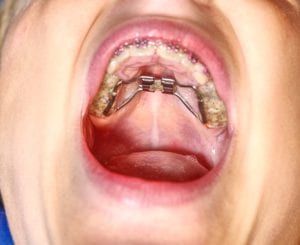 palate expander shown in mouth