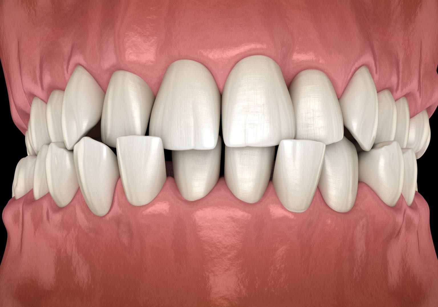 How Your Orthodontist Fixes a Crossbite