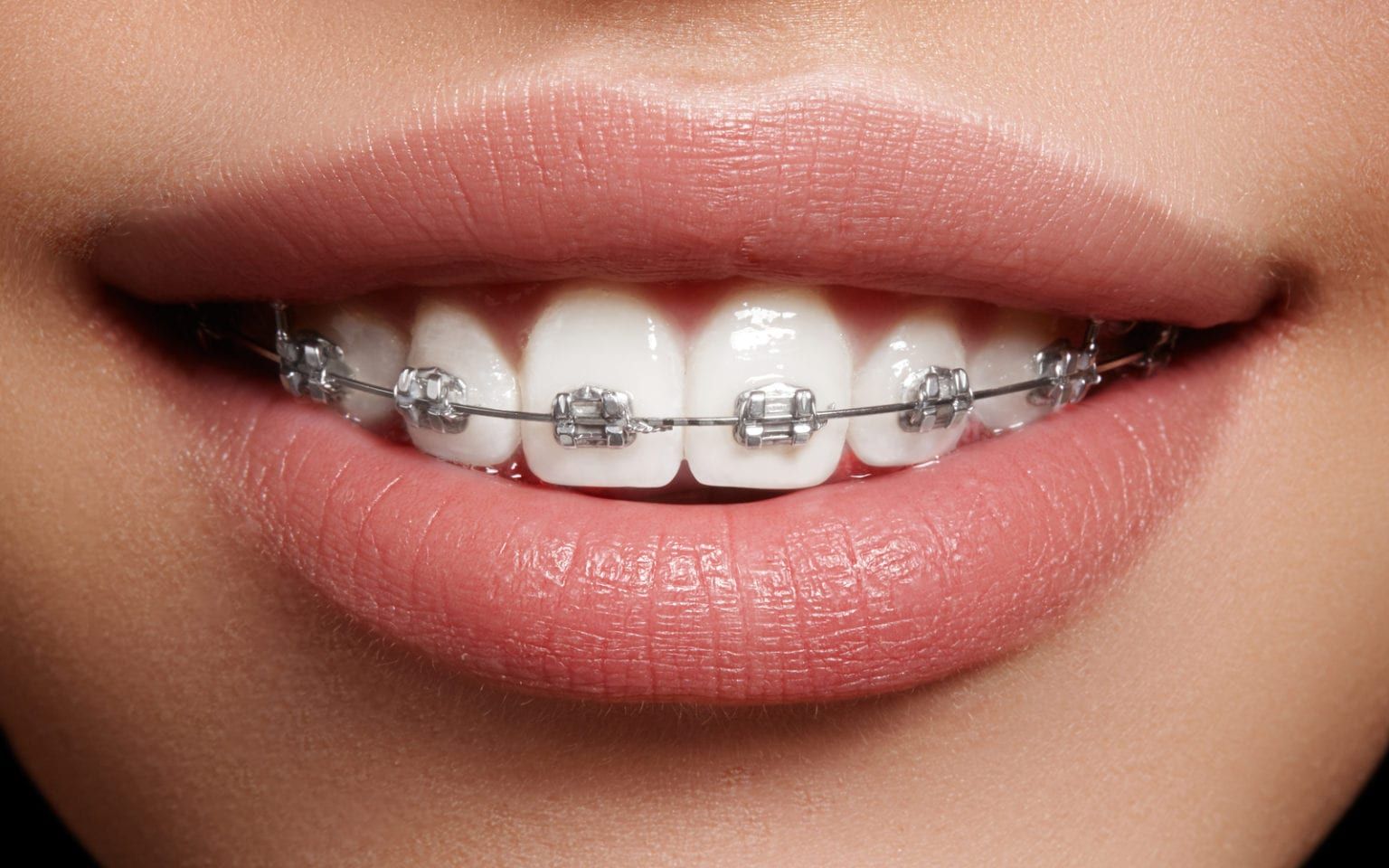 How Nickel, Copper, and Cobalt are Changing Braces Massih Orthodontics