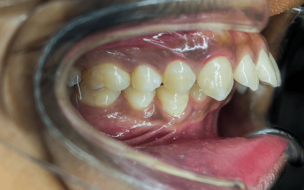 Causes Of Protruding Teeth And The Associated Dental Risks