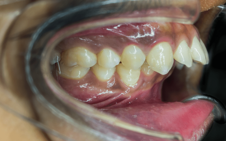 Protruding teeth