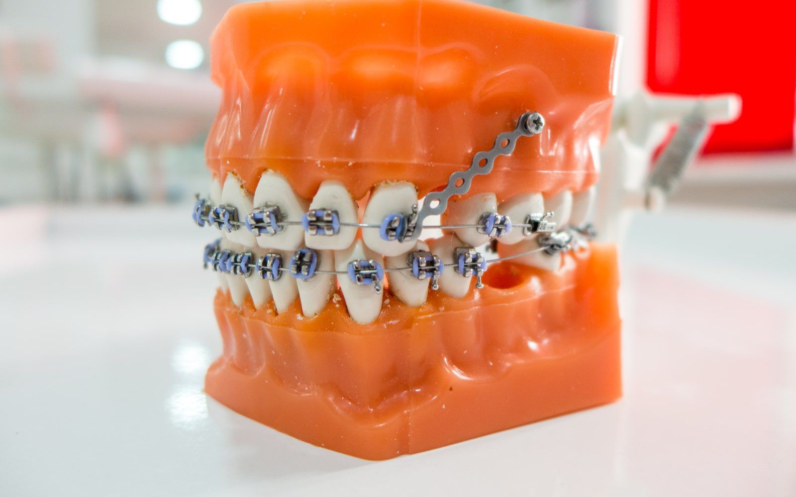 The Role Of Orthodontic Anchorages In Treatment Massih Orthodontics