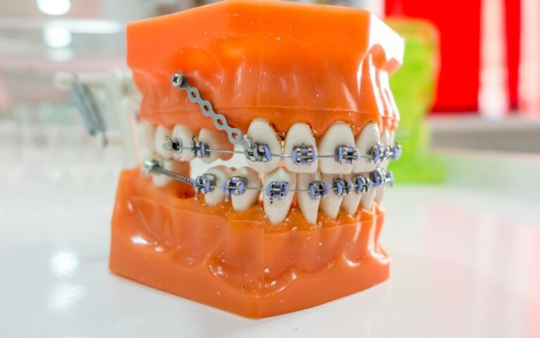 Orthodontic anchorage model