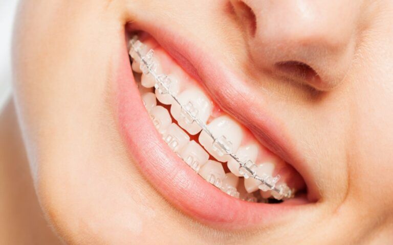 Ceramic Orthodontics